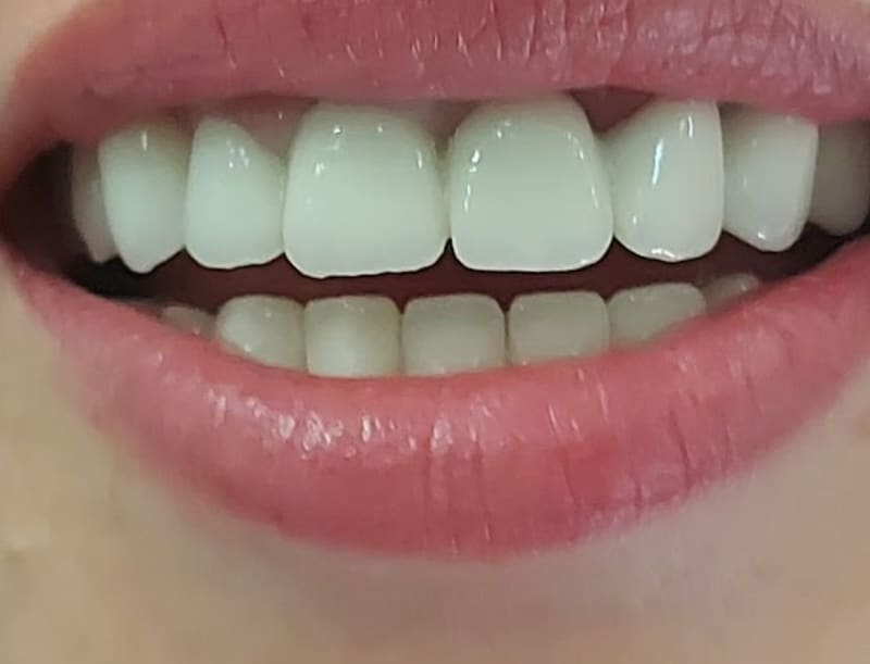 Osmeh izbliza, sa bezmetalnom cirkon keramikom u obe vilice.